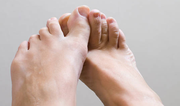 Micose dos pés: o que é, formas clínicas e tratamento